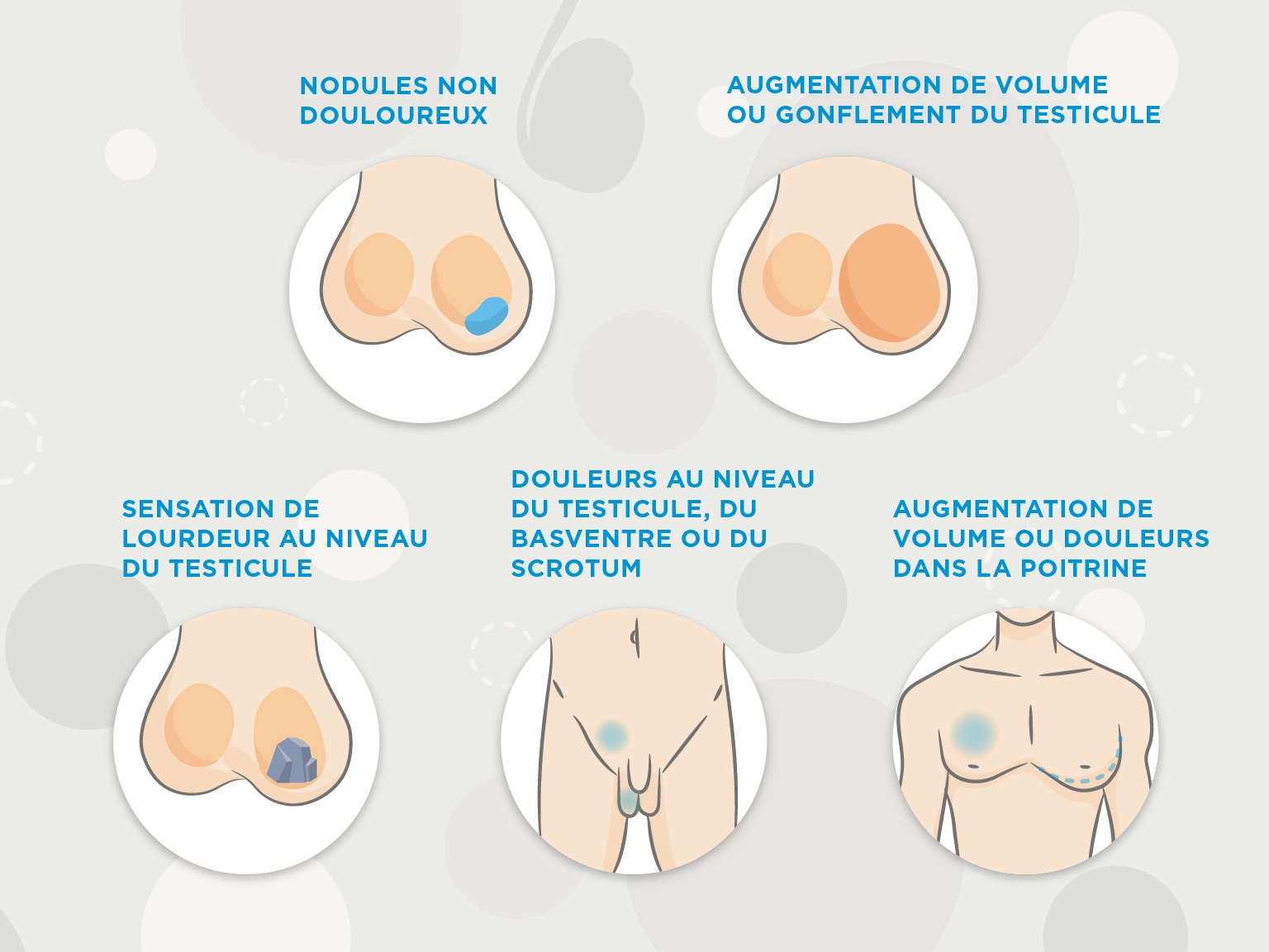 Cancer du testicule : je comprends sa découverte et son évolution